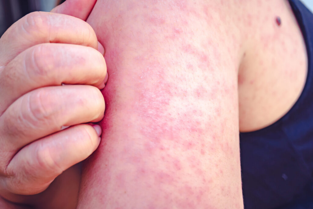 Diseases like measles have surged to the highest level in decades in the United States.(Photo by Getty Images Plus)